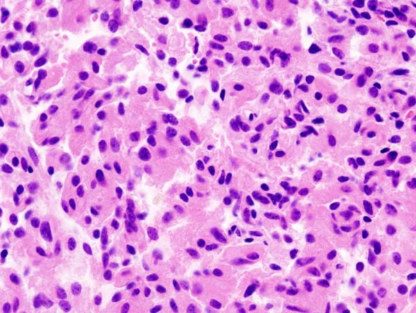 Microscopic image of a pituitary adenoma